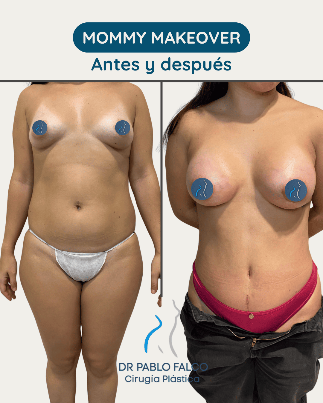 Antes y después Mommy Makeover — paciente 1