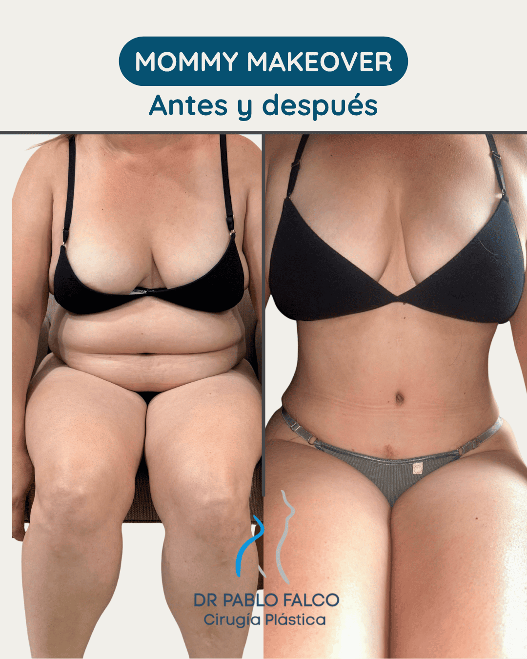 Antes y después Mami Makeover — paciente 2