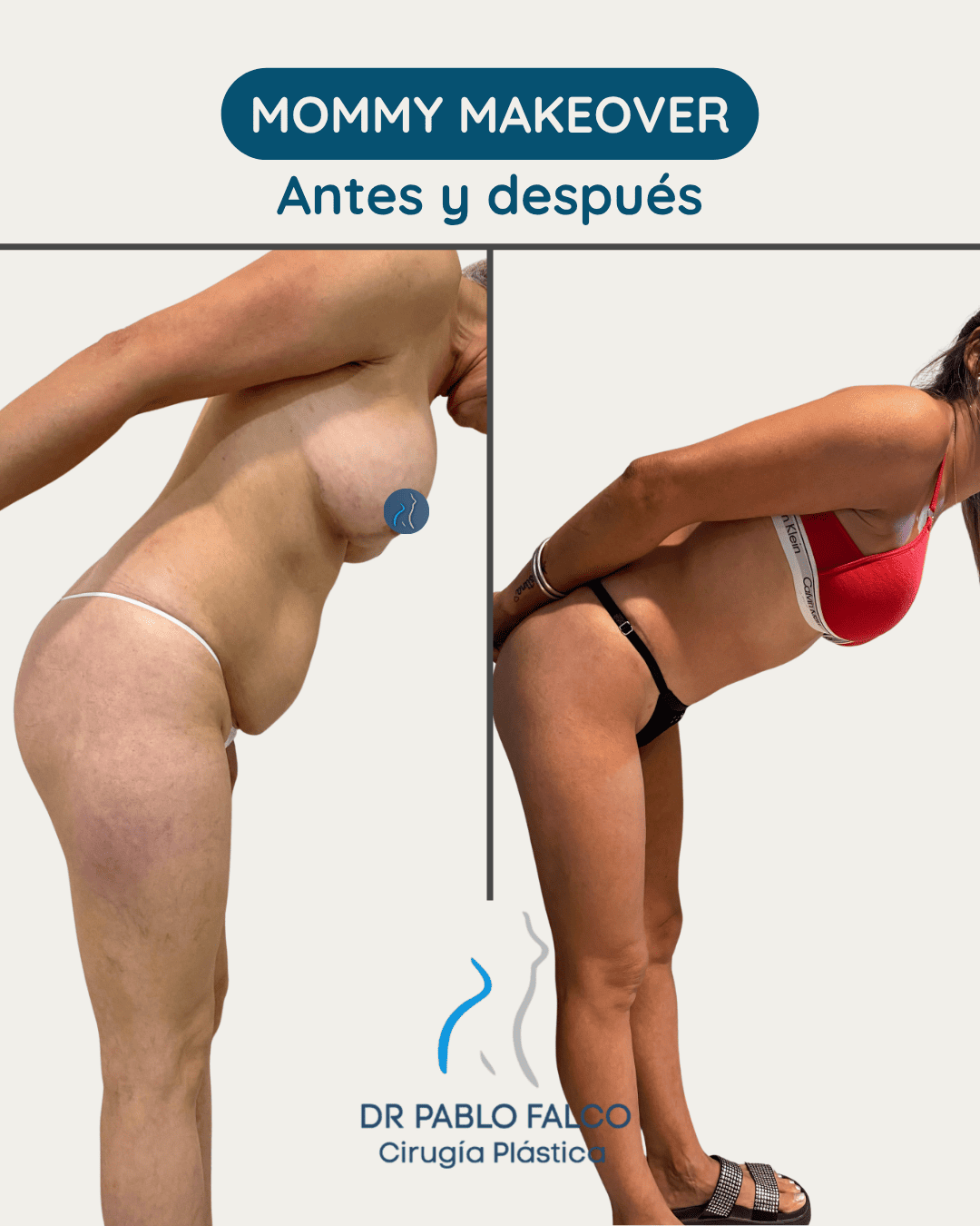 Antes y después Mami Makeover — paciente 3